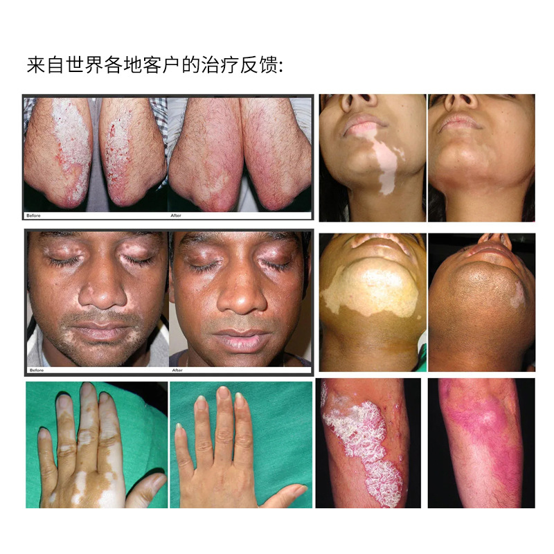 2025 New Professional Clinic Applicable 308Nmuvb Phototherapy Lamp Psoriasis Vitiligo Treatment Equipment