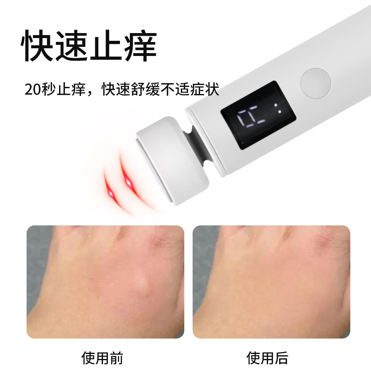 Rechargeable Electric Massage Anti-itch Instrument, Digital Anti-itch Device, Physical Anti-itch Artifact, Summer Mosquito Bites and Itching