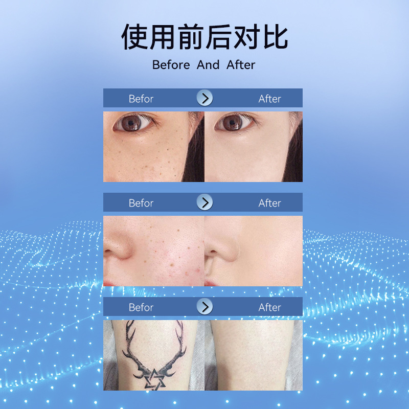 Meiji Russian Hot-Selling Electric Mole Removal Pen Small White Spots Laser Removal Metal Body Beauty Pen