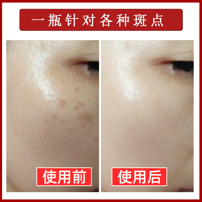 Anti-Freckle Liquid, Anti-Freckle Liquid, Non-Peeling Light Spot Essence, Removes Chloasma, Freckles, Sun Spots, Beauty Salon Non-Invasive Spot Dissolving Liquid