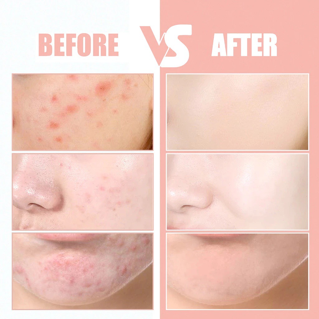 Multi-cartoon color PE acne sticker hydrocolloid paper plastic aluminum foil bag source factory cross-border wholesale Southeast Asia