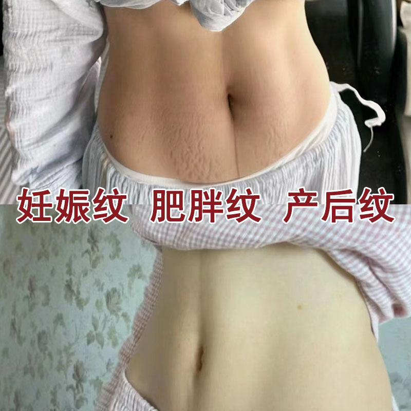 Крем для восстановления кожи после беременности, удаление растяжек