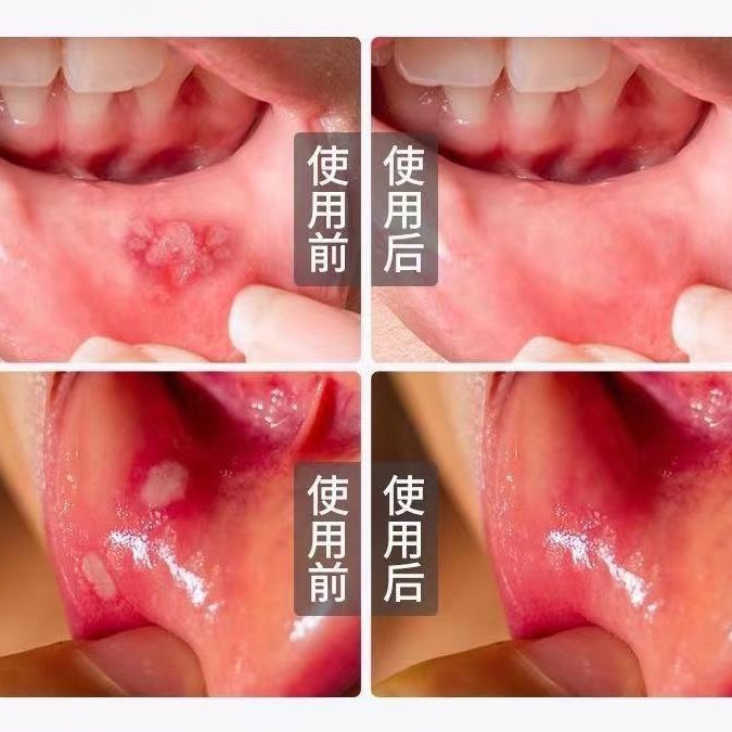 Nanjing Tongrentang Gel Oral Spray Fire Rotten Mouth Tongue Oral Aphthous Sores Fire Spray