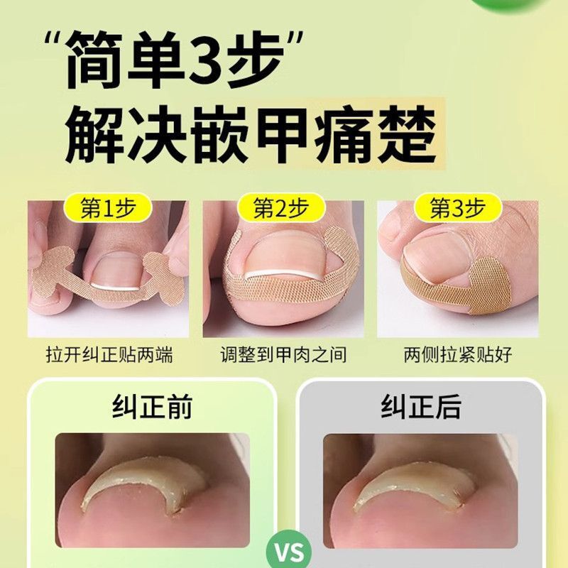 New Glue-Free Nail Patch for Toenails, Nail Groove Ingrown Toenail Orthosis, Toenail Patch for Manicure