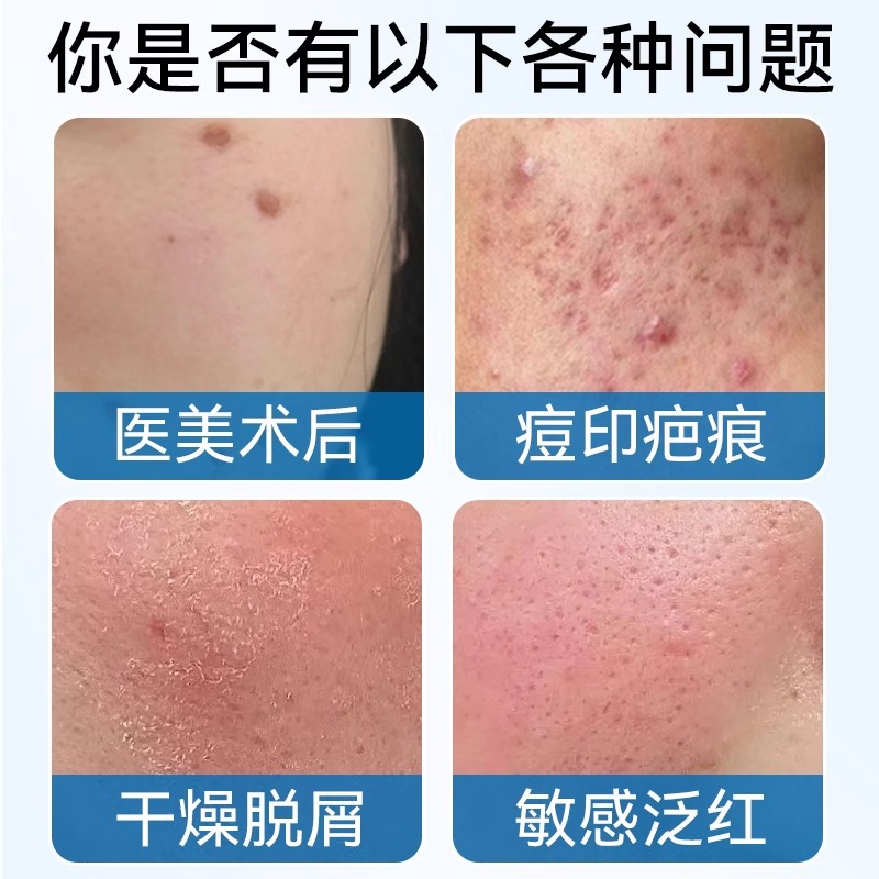 Touneng pharmaceutical medical sodium hyaluronate skin repair gel sterile 20g/wholesale a generation of hair