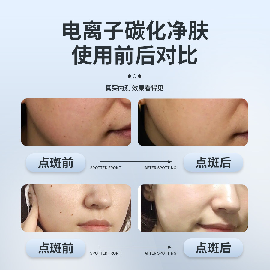 White Spot Mole Pen Laser Freckle Removal Beauty Device, Special Pen for Beauty Salons and Home Use