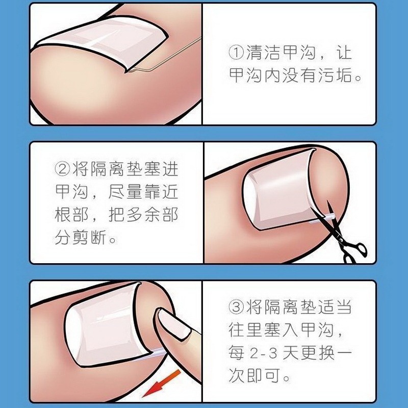 Nail C- type pad nail groove nail inflammation filling gasket corrector nail stick nail nail nail nail nail tie meat artifact