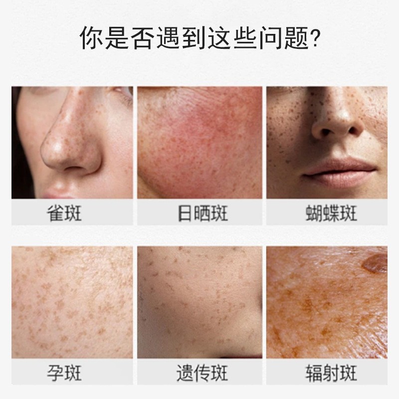 Spot Cream Removes Freckles, Age Spots, Dermal Spots, Chloasma, Facial Care, Spot Cream, Lightens Spots, Repairs and Whitens