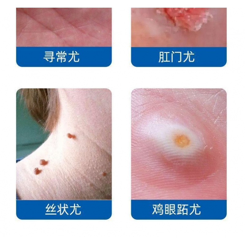 Medical Liquid Nitrogen Freezing for Home Use in a Bottle! ! ! ! ! Authentic Mail to Your Home