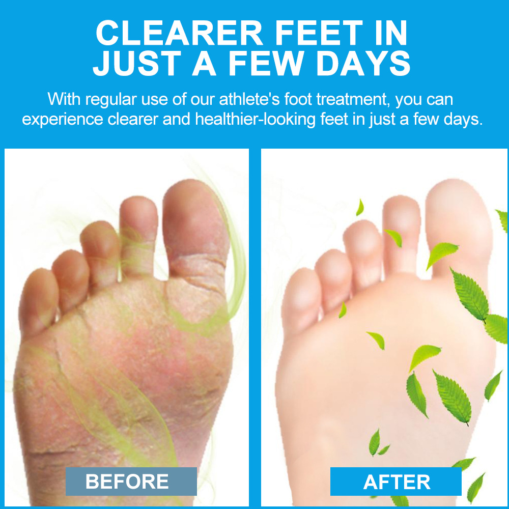 Sumifun Tea Tree Oil Athlete's Foot Cream Itchy Feet Amazon Cross-Border Foreign Trade Overseas Store Supply K10197