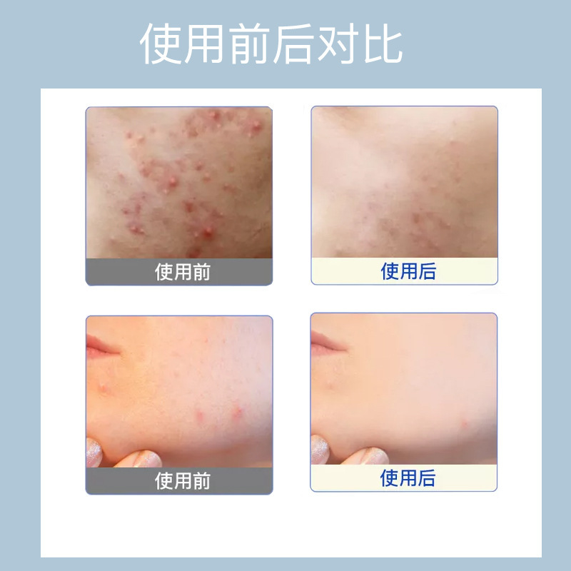 Beauty Salon and Large Oligopeptide Freeze-Dried Powder for Repairing Acne Marks, Bare Bottle Manufacturer Wholesale, Paid Samples Available, Repair and Moisturize