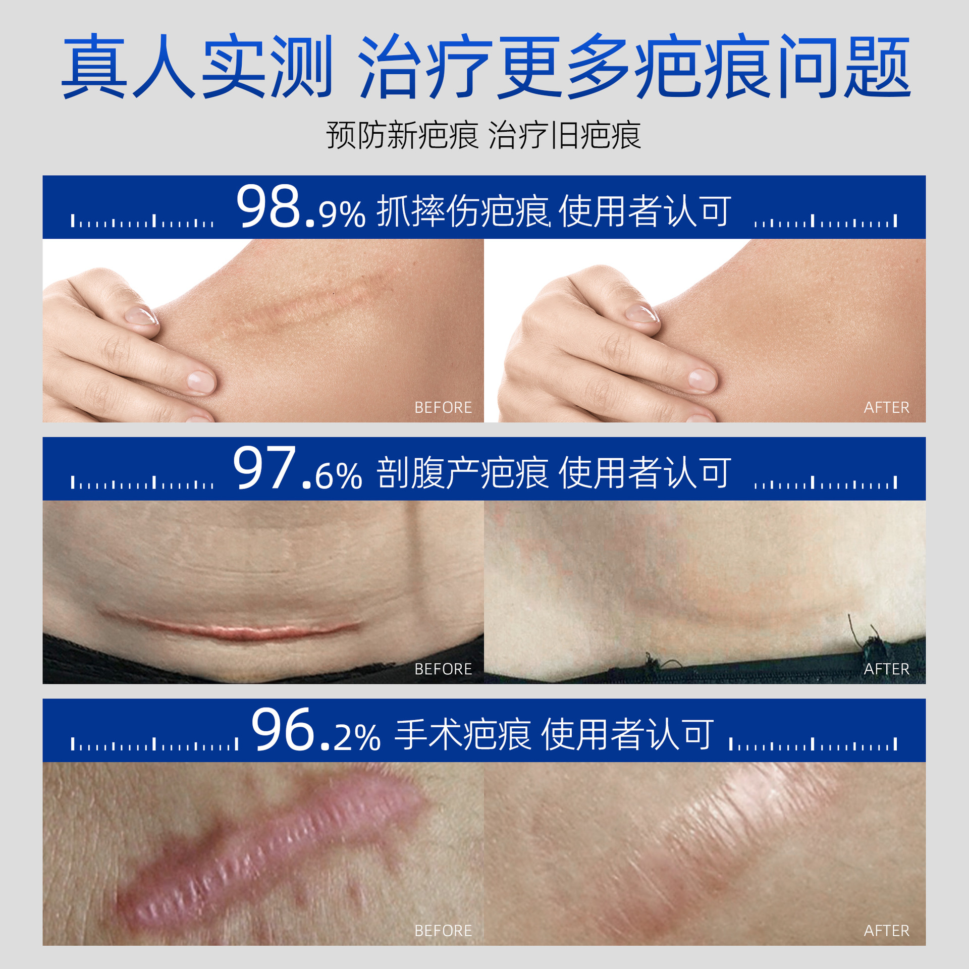 Scar Removal Cream, Silicone Gel for Removing Scars, Children's Burns, Caesarean Section Scar Repair, Support for Oem Customization and Dropshipping