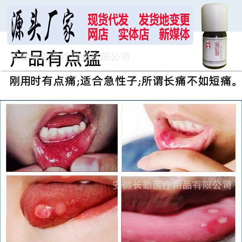 Changqin Brand Yidian Lingzheng Oral Gel for Mouth Sores, Zhengfeng Linjin Kuilingning Herbal Tea for Sores, Clearing and Repairing Sores