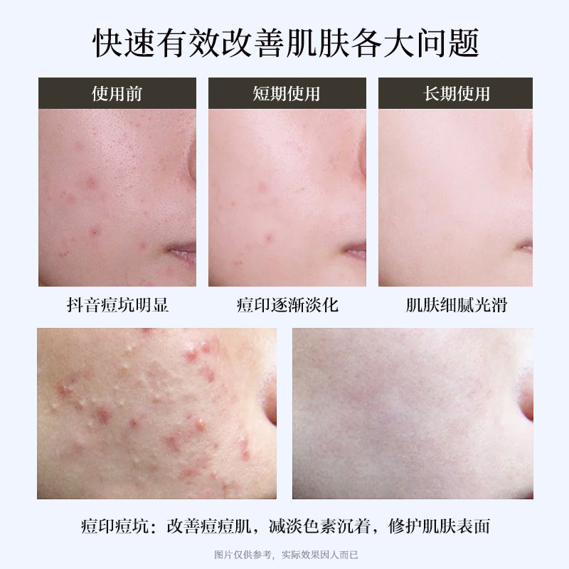 Medical Recombinant Collagen Freeze-dried Fiber Mechanical Type II Microneedle Water-light Introduction