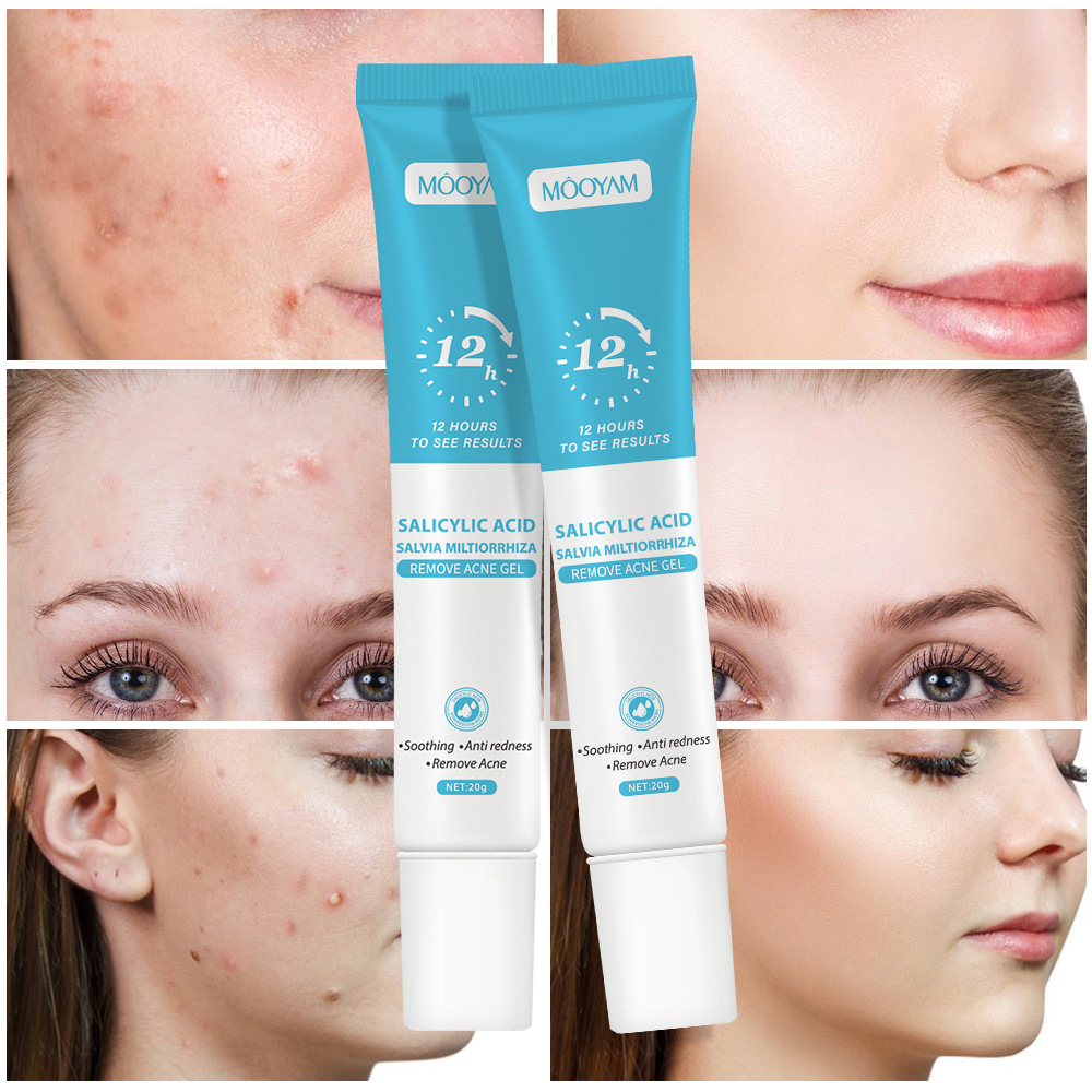 Cross-Border Salicylic Acid Anti-Acne Cream Fades Acne Marks, Removes Acne, Closes Mouth, Shrinks Pores, Plant Essence Anti-Acne Gel