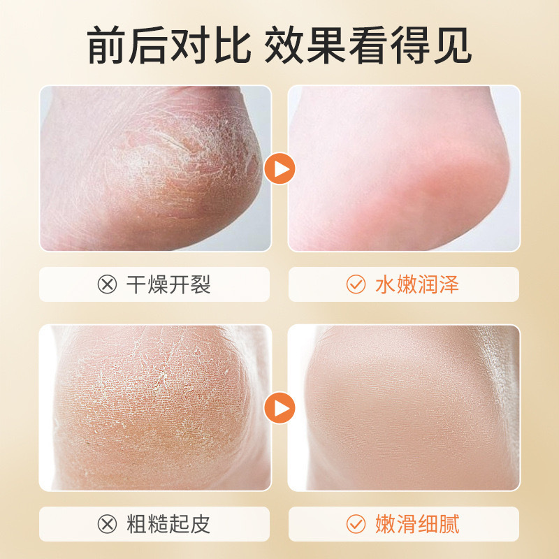 Dr. Yumei's Cracked Heel Gel for Chapped Hands, Peeling and Cracked Hands and Feet Moisturizing Cream Heel Moisturizer Wholesale