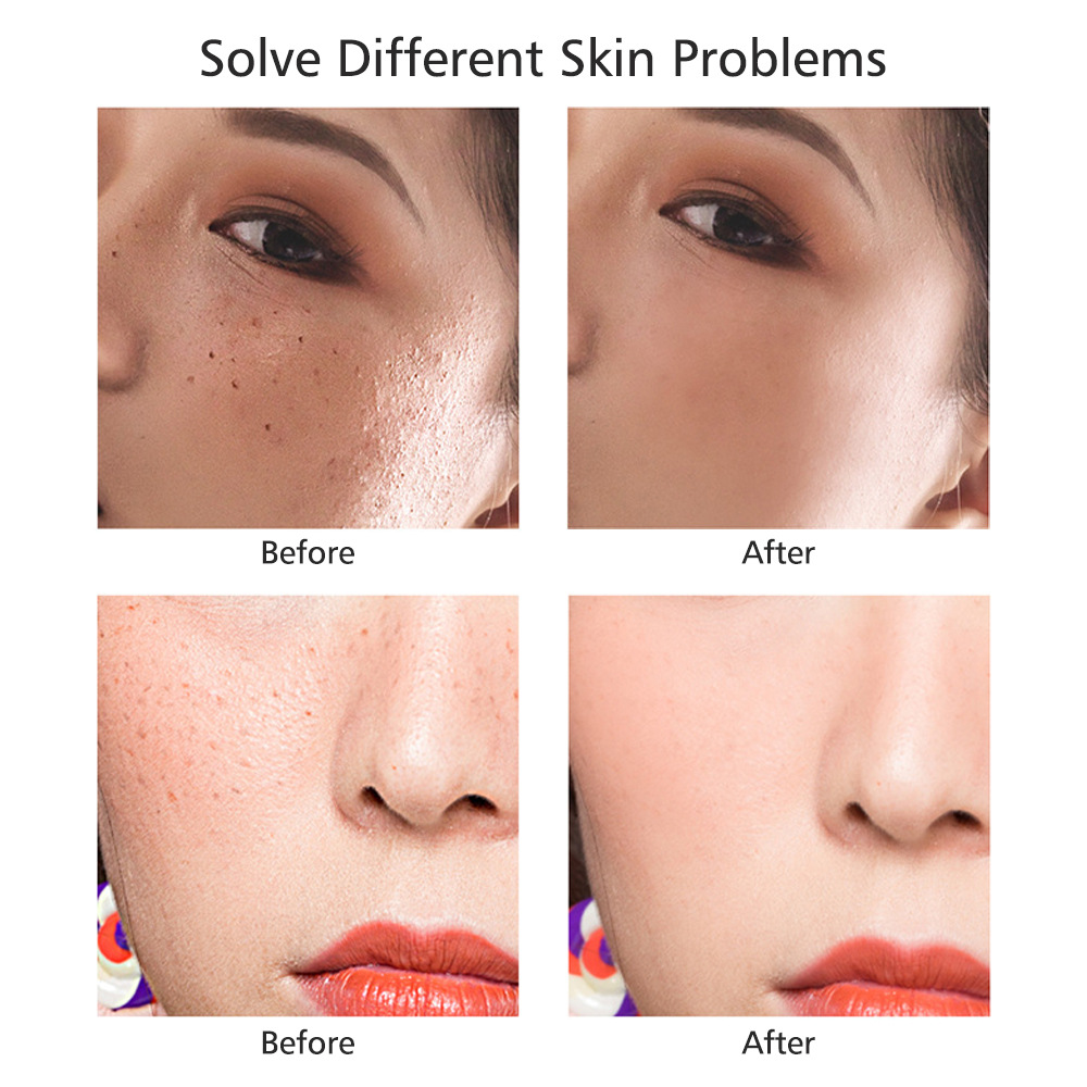 Мини-ручка для удаления пятен, лазерный косметический аппарат, инструмент для салонов красоты, USB-подключение, кросс-бодер, бестселлер