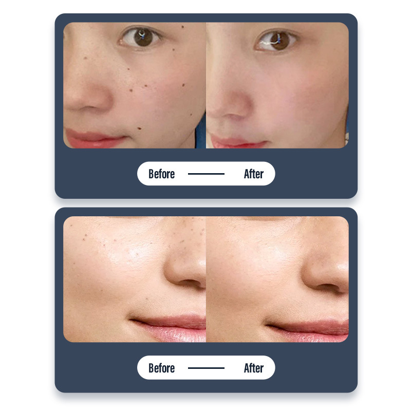 Household Dot mole pen spot sweeper needle beauty spot sweeper red blue light beauty rejuvenation instrument wholesale