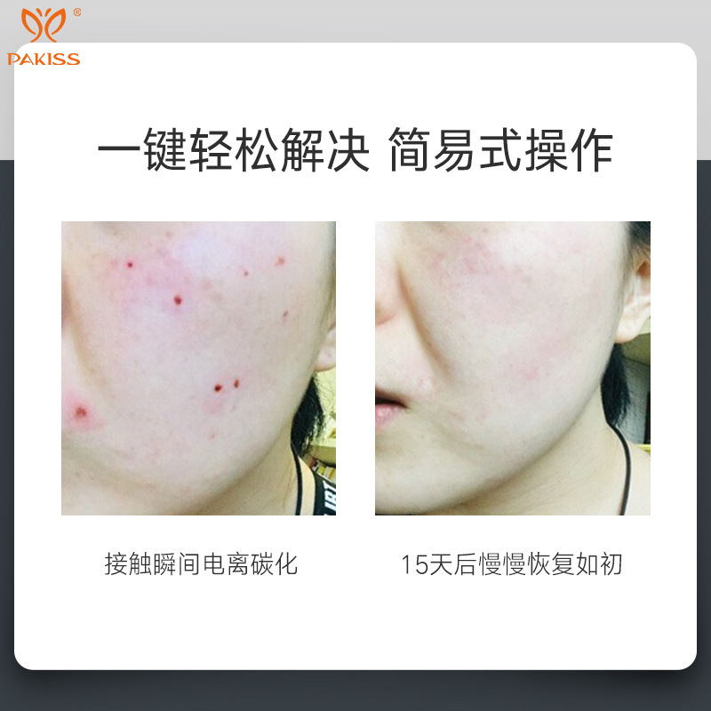 German White Laser Freckle Removing Pen for Sweeping Spots and Mole Removing Spots for Hemorrhoids and Mole Removing Pen for Beauty Salon