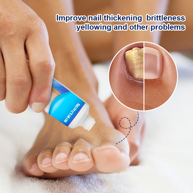 Lazada Aliexpress Sumifun Cross-Border 20g Nail Cream Onychomycosis Soft Nail Removal Ointment K10010
