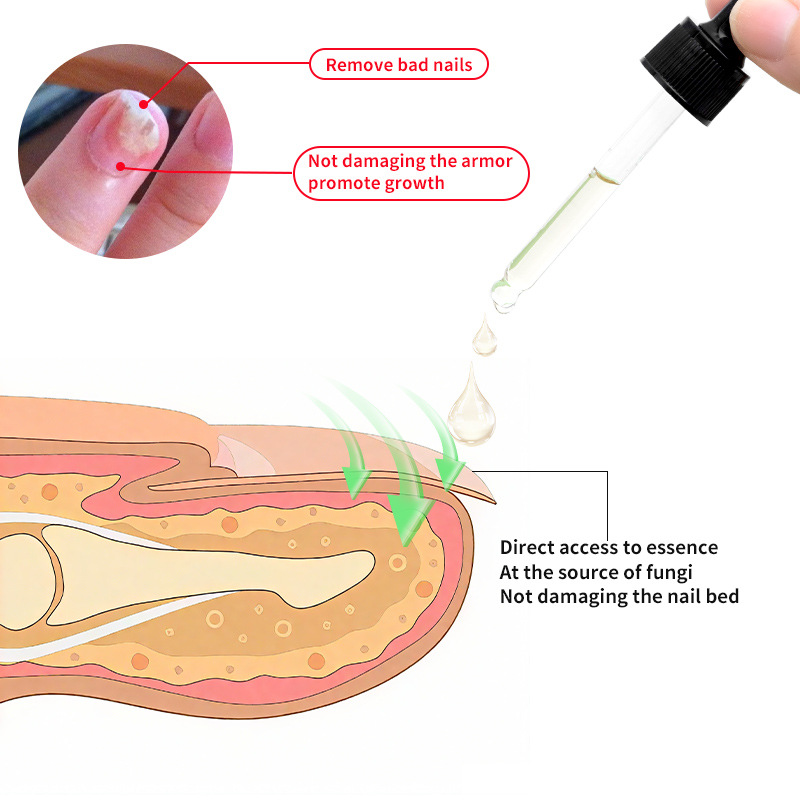 Cross-Border Akck Ginger Nail Care Solution Onychomycosis Repair Hand and Foot Nail Care Soft Nail Brightening Nail Moisturizing Solution