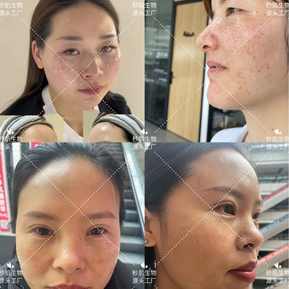 Beauty Salon Repair Factor Postoperative Non-invasive Instrument Repair Dot Mole Spot Thickening Corneous Redness Ice Crystal