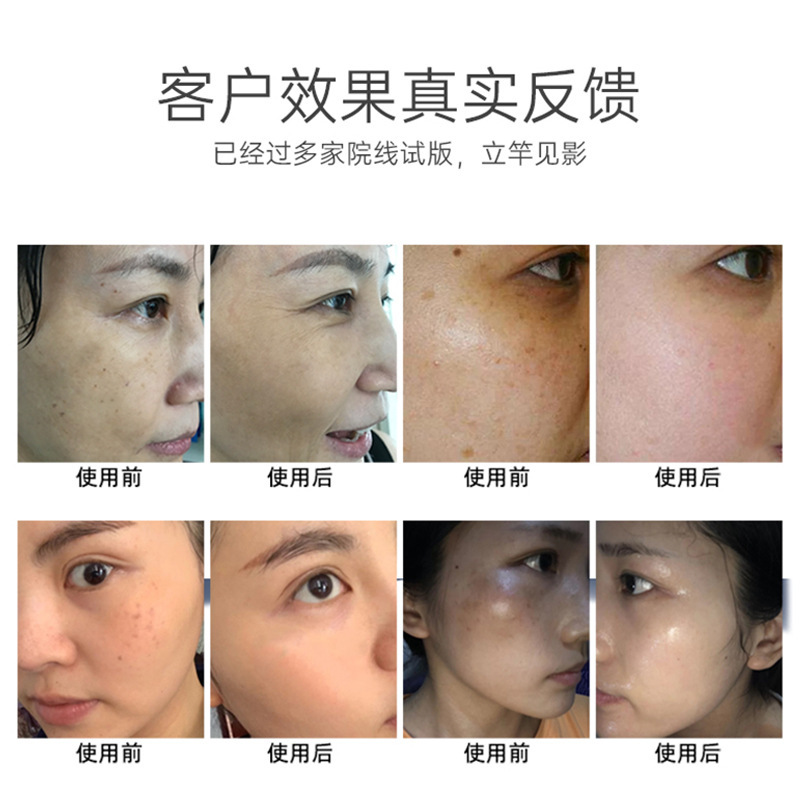 Anti-Freckle Liquid, Anti-Freckle Liquid, Non-Peeling Light Spot Essence, Removes Chloasma, Freckles, Sun Spots, Beauty Salon Non-Invasive Spot Dissolving Liquid