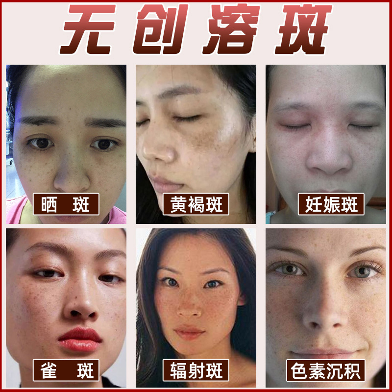 Anti-Freckle Liquid, Anti-Freckle Liquid, Non-Peeling Light Spot Essence, Removes Chloasma, Freckles, Sun Spots, Beauty Salon Non-Invasive Spot Dissolving Liquid
