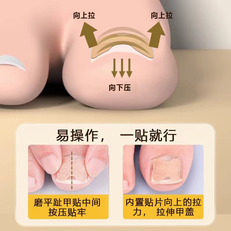 Jiagou nail paste toe nail paste manufacturers prevent to grow in the meat to improve the Jiagou roll nail paste suit patch