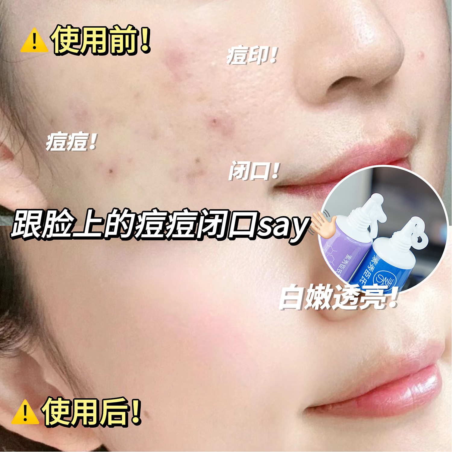 Su Xiu Chen's Heparin Sodium Ointment Vitamin A Rejuvenating Cream Improving Pimples Close the Mouth, Delicate Skin Rejuvenation and Moisturizing Ointment