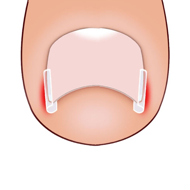 Nail Pad Nail Groove Inlay Nail Corrector Nail Pad Roll Nail Corrector Pull and Stick Toenail Long into Meat