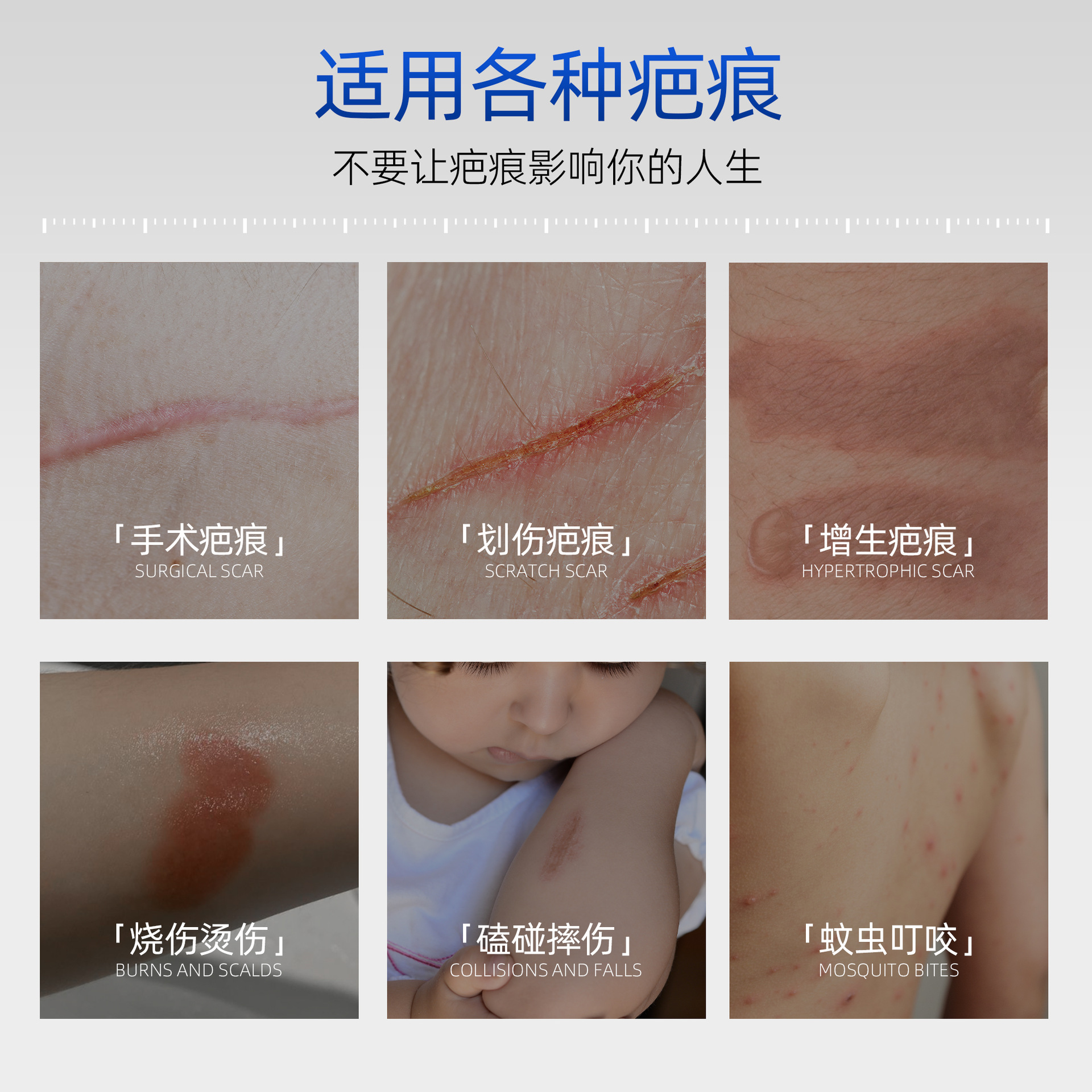 Scar Removal Cream, Silicone Gel for Removing Scars, Children's Burns, Caesarean Section Scar Repair, Support for Oem Customization and Dropshipping