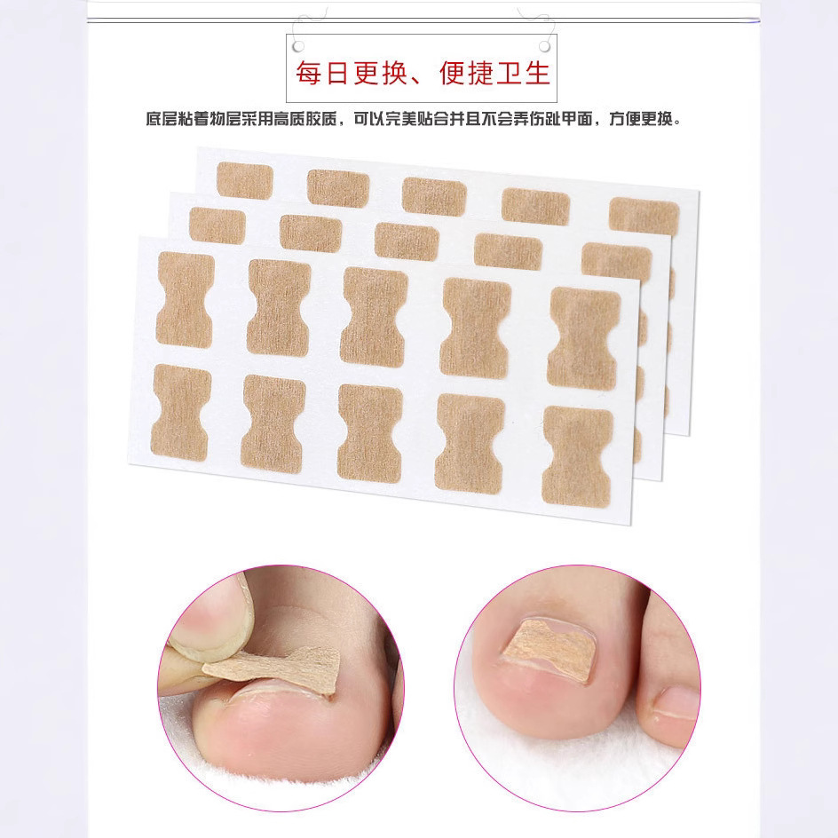 in stock nail stickers toenail nail straightener toenail long meat glue-free pull correction stickers