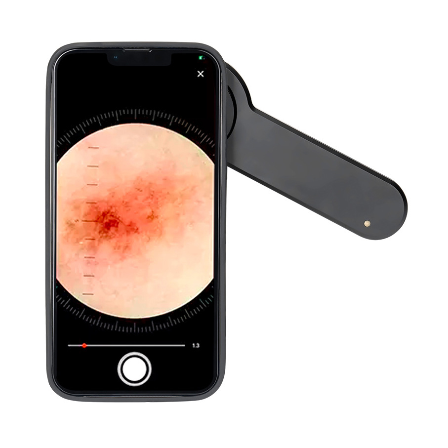 IBOOLO mobile phone Skin Analyzer skin cancer diagnosis 10X medical HD handheld skin mirror