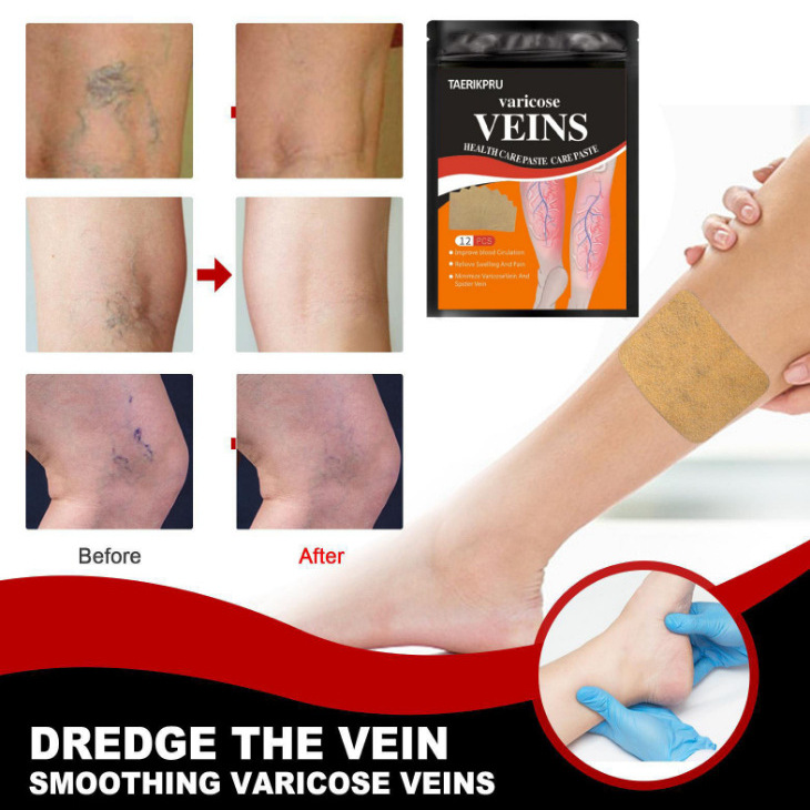 Cross-Border Varicose Repair Patch, Varicose Vein Relief, Leg Vein Protruding Pain Varicose Repair Patch