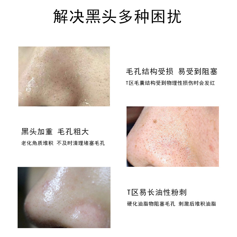 Beauty Salon Blackhead Removal Exporting Essence Small Bubbles Cleansing Softening Acne Removal Exquisite Pores Water Set