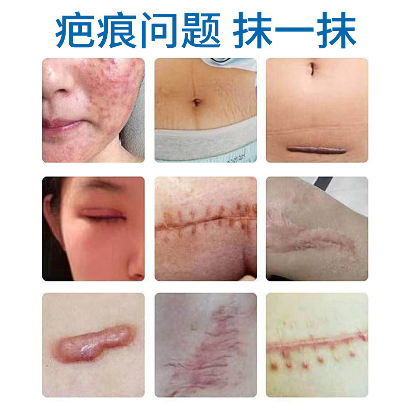 Zhuo Physician Brand Medical Silicone Scar Very Gel Skin Discomfort Cream Ointment E-Commerce Goods Source Wholesale