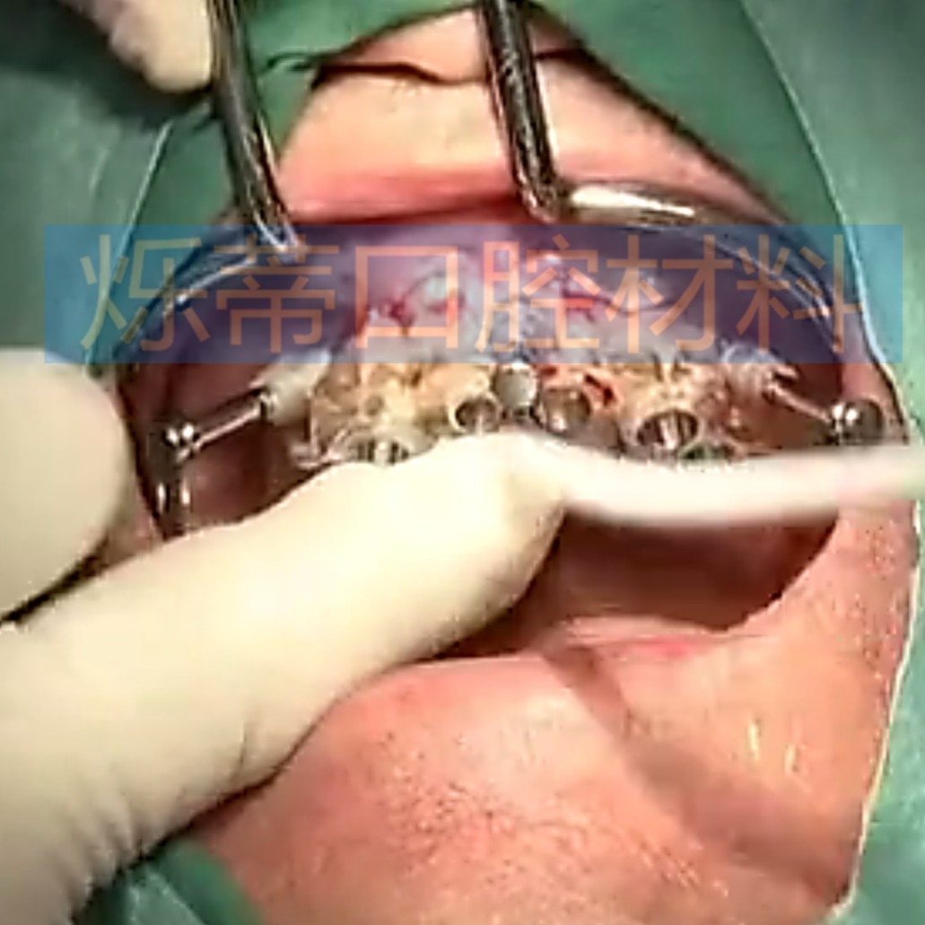 Dental Oral retractor stainless steel T planting retractor mouth opener lip/buccal dental instrument