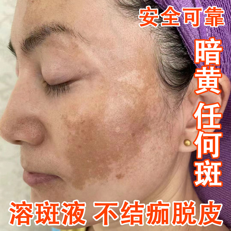 Жидкость против веснушек, не обладающая отшелушивающим эффектом, эссенция для осветления пятен, удаляет хлоазму, веснушки, солнечные пятна, неинвазивная жидкость для растворения пятен в салоне красоты