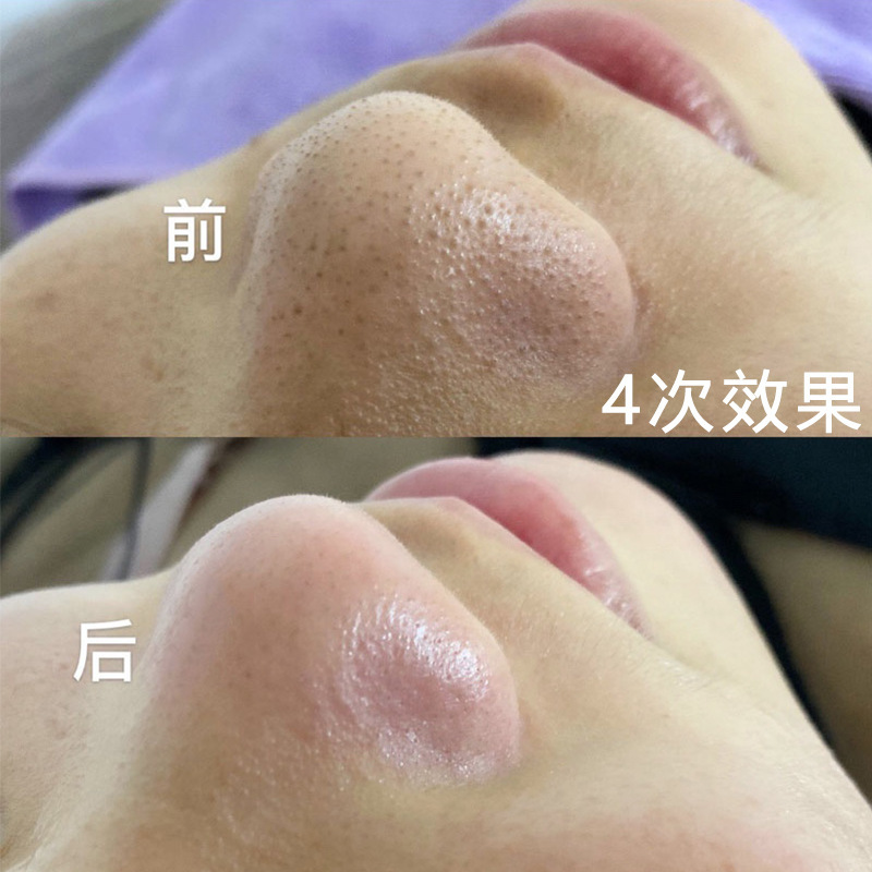 Hair Follicle Cleansing Cream, Purifying Cream, Beauty Salon Specializes in Shrinking Pores, Deep Cleansing Cream, Removing Blackheads, Facial Massage Cream