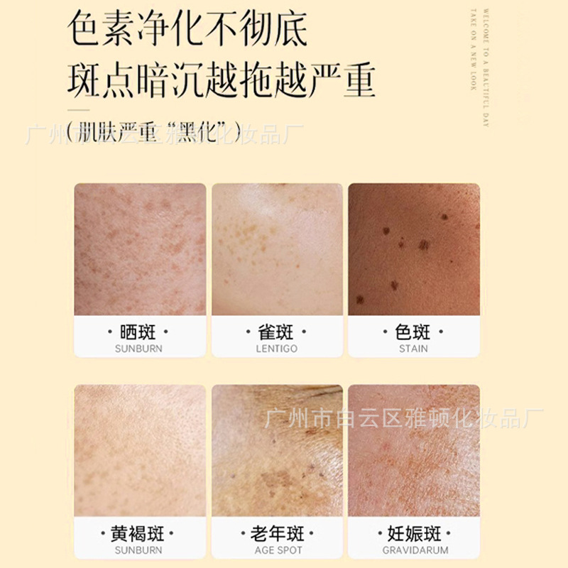 Whitening and Freckle Removal Cream Set, Beauty Salon Brightening Skin, Age Spots, Chloasma, Freckles, Lightening Fine Lines, Bulb Skin Set