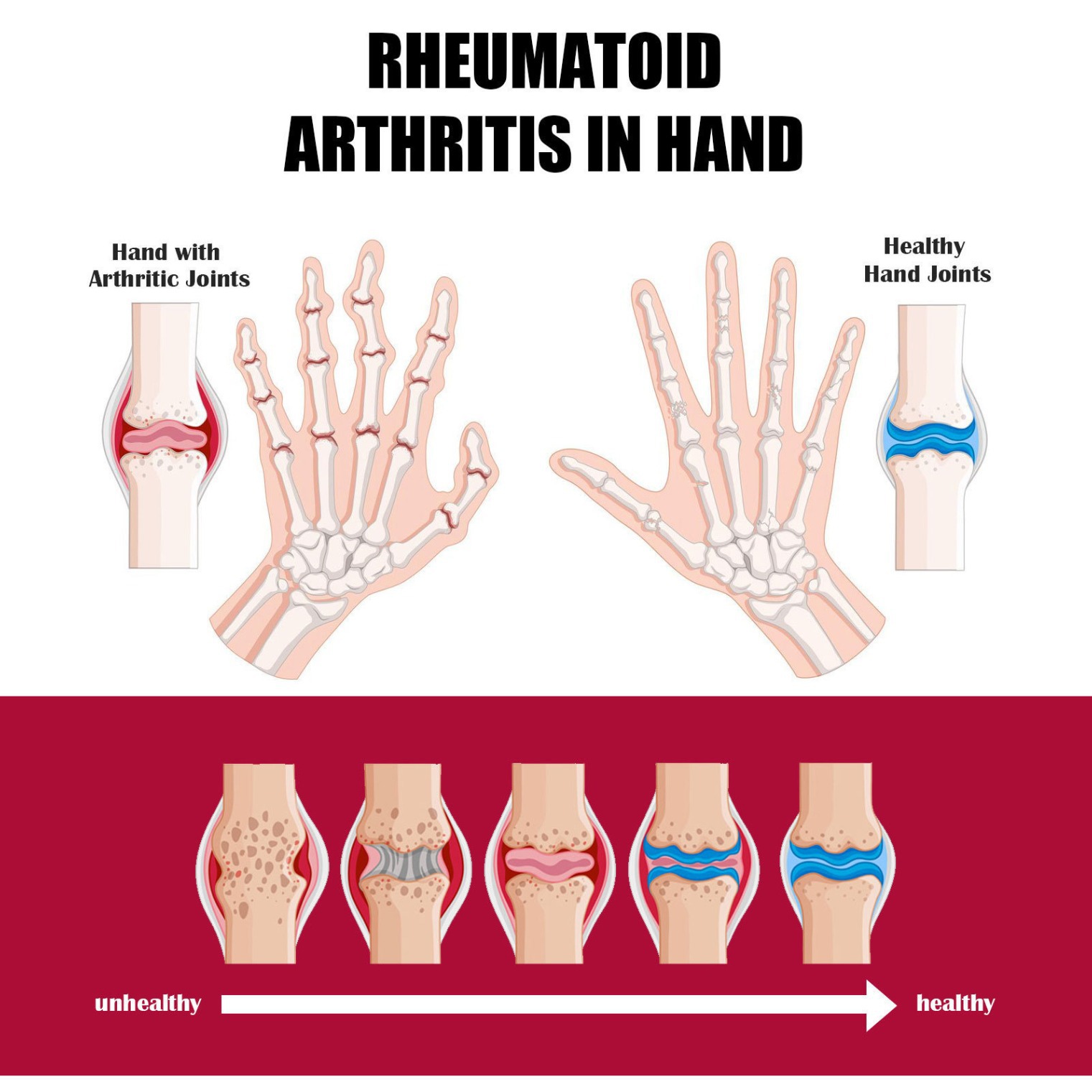 Joint bone collagen cream to relieve joint bone pain deformation correction repair boxed factory direct sales