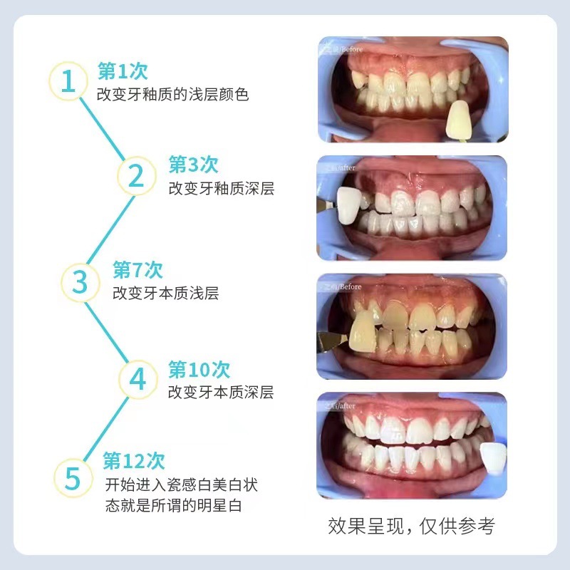 In stock brand Original Tooth pigment extraction whitening gel teeth care teeth beauty can be designed