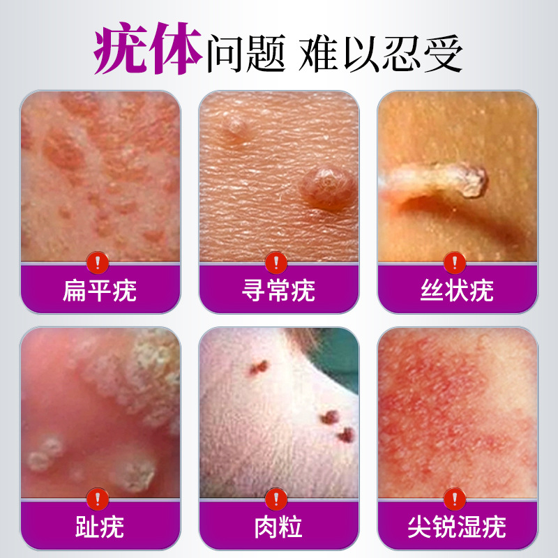 Sunflower Medical Wart Remover for Flat Warts, Filamentous Warts, Facial Medicine, Special for Neck, Removes Small Flesh Lumps and Warts