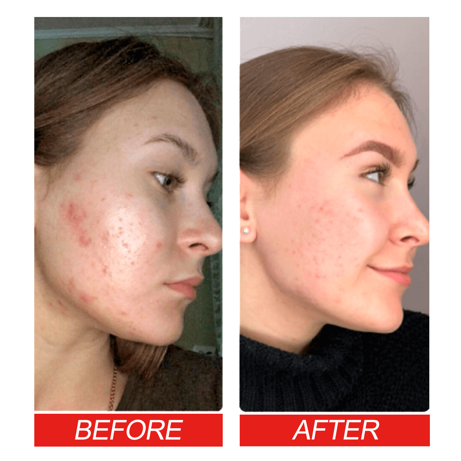 Jaysuing Acne Patch Series Facial Care Cleansing Closure Mouth Gentle Fading Acne Balancing Skin Acne Patch