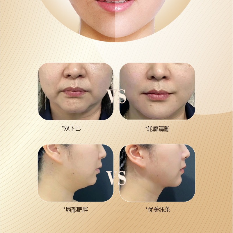 Special Gold Non-invasive Protein Essence for Hospital Lines, Double Chin Mother's Butt Rich Bag, Whole Body Shaping Protein Liquid