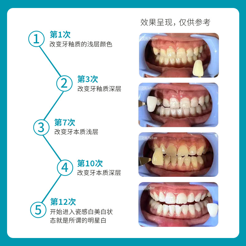Three Minute Teeth Raw Teeth Pigment Extract Gel Hydrogen Peroxide Teeth Whitening Agent Zhenmei Angel Same Style