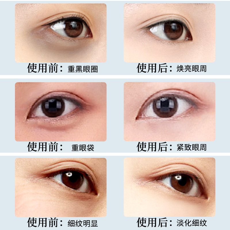 Hanrunyi Manufacturer Wholesale Moisturizing and Hydrating Eye Mask to Reduce Dark Circles and Eye Bags Eye Mask to Brighten the Eye Area Eye Mask Patch