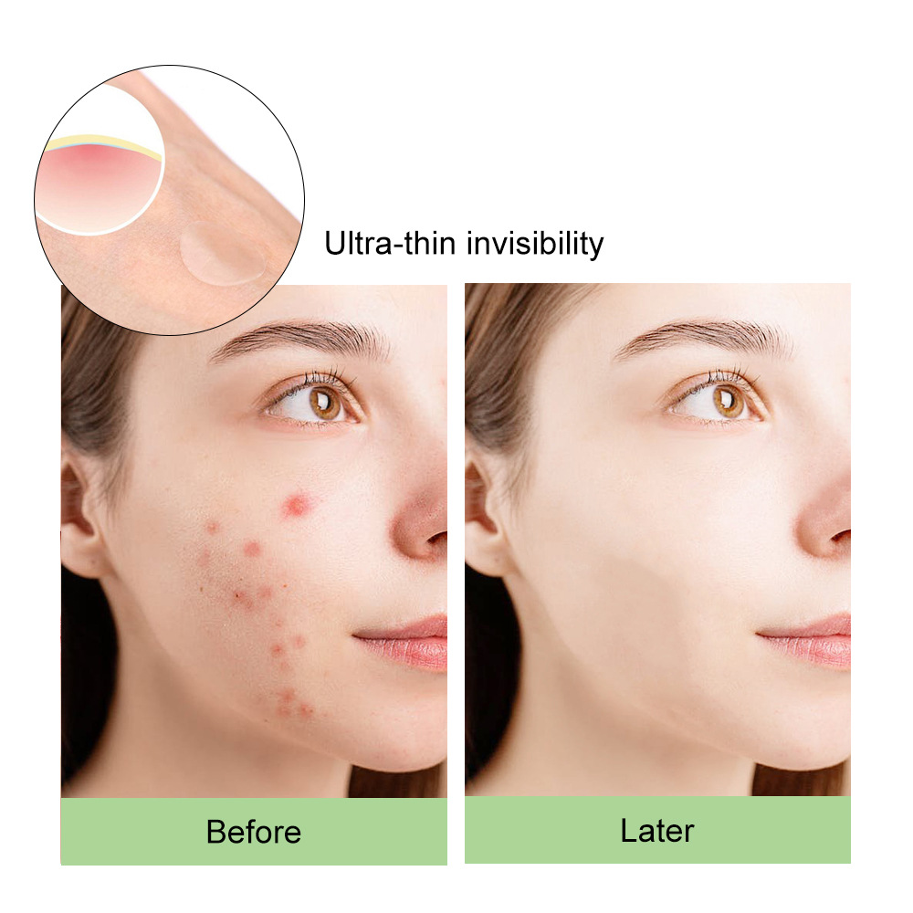 Invisible Transparent Particle Acne Patch Pe Self-Adhesive Covering Skin Invisible Tattoo Makeup Concealer Patch