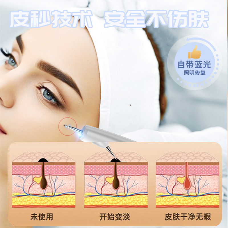 Small White Spot Mole Pen, Laser Freckle Removal and Molole Beauty Instrument, Hemorrhoid Spot Molole Pen, Beauty Salon Special Molole Spot Pen